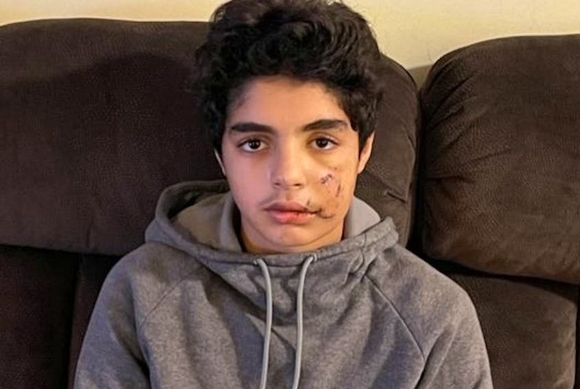 Muhammad Alzghool, 13, is seen with stitches after a dog attack.