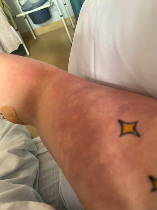 Danica Pettipas, who turned 30 in March, was hospitalized with COVID-19 on Friday. She shows her arm which developed red and blue blotches as a result of the disease. - Contributed by Pettipas