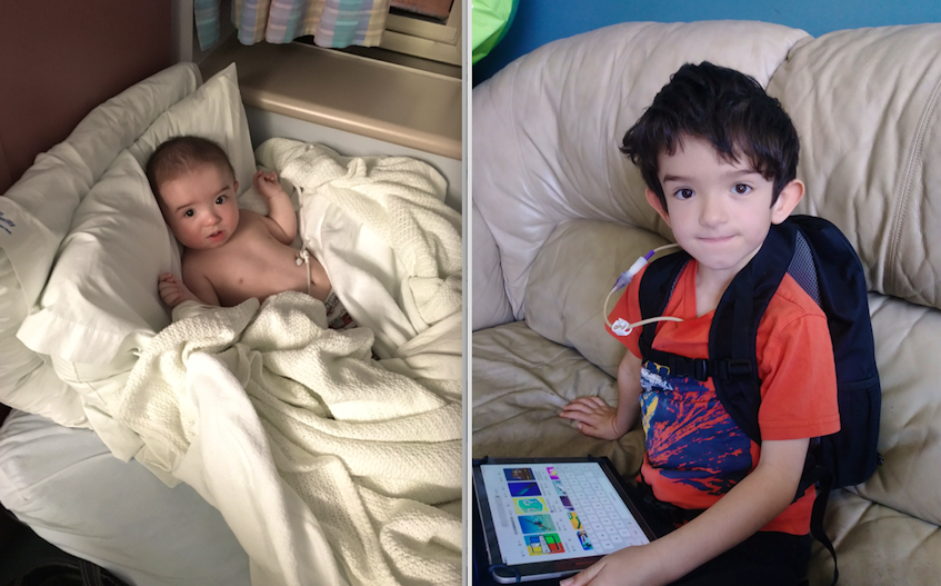 Ben Cosman as a baby (left) with his feeding tube. A more recent photo of Ben (right) wearing his backpack that includes a feeding pump to keep him nourished through his feeding tube. CONTRIBUTED 