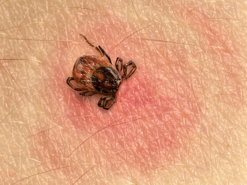 Lyme disease – an illness caused by a bite from an infected tick - can be one of the hardest diseases to diagnose in Canada. - Contributed
