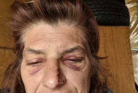 This photo illustrates the injuries that Karen Haggerty of Windermere suffered to her face after having a grand mal seizure in Berwick and falling to the pavement. CONTRIBUTED