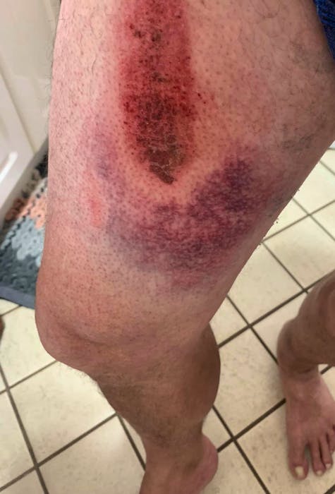 Bobby Pyke shows his injuries following his August accident on his ATV on the Coal Town Trail. He has since recovered. CONTRIBUTED - Contributed