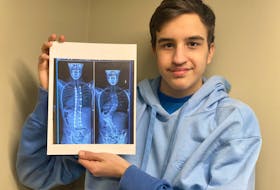 Sixteen-year-old Dominic Boudreau of Yarmouth County holds a photograph of before and after x-ray images of his spine that was straightened by surgery in June 2021. TINA COMEAU PHOTO 
