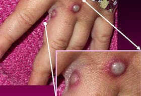 Photo released by the Centers for Disease Control and Prevention showing lesions caused by infection with the monkeypox virus. 