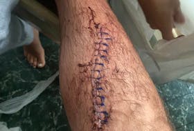 Dave Ryan's leg after he suffered a chainsaw injury while clearing a friend's driveway in Country Harbour, Guysborough County.