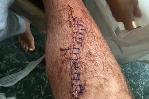Dave Ryan's leg after he suffered a chainsaw injury while clearing a friend's driveway in Country Harbour, Guysborough County.