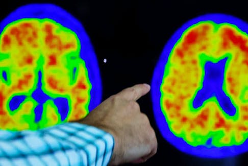 A doctor points out evidence of Alzheimer's disease on PET scans at the Center for Alzheimer Research and Treatment (CART) at Brigham And Women's Hospital in Boston, Massachusetts, U.S., March 30, 2023.    