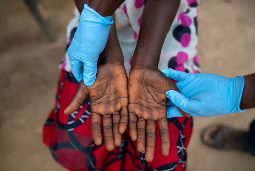 Alingo Likaka Manasse, head nurse at the Yalanga Health Centre, examines lesions on the hands of Lituka Wenda Dety, 41, who is suffering from mpox, in Yakusu, Tshopo, Democratic Republic of the Congo, October 2, 2022.