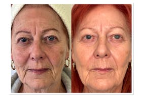 With the cutting-edge NeoGen Plasma device, clients can get a facelift look without invasive plastic surgery or long recovery time. Pictured is a client before using the device (left) and 90 days after. PHOTO CREDIT: Youthful You Medaesthetics.