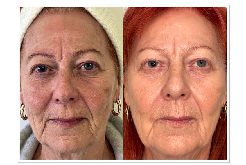With the cutting-edge NeoGen Plasma device, clients can get a facelift look without invasive plastic surgery or long recovery time. Pictured is a client before using the device (left) and 90 days after. PHOTO CREDIT: Youthful You Medaesthetics.