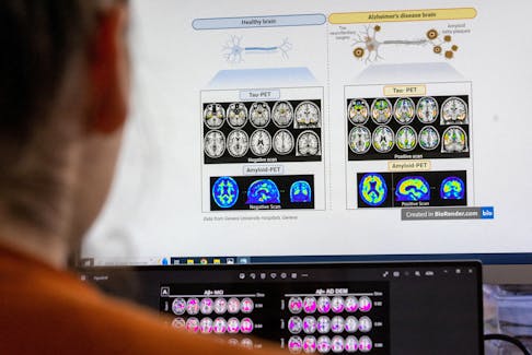 A scientist looks at scans of brains at the Memory Centre at the Department of Readaptation and Geriatrics of the University Hospital (HUG) in Geneva, Switzerland, June 6, 2023. 