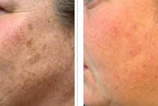 Before and after treatments for sunspots. These photos are 28 days apart.