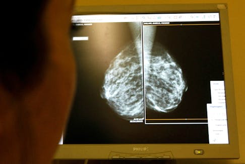 A doctor exams mammograms, a special type of X-ray of the breasts, which is used to detect tumours as part of a regular cancer prevention medical check-up at a clinic in Nice, south eastern France, on January 4, 2008.      