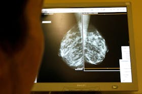 A doctor exams mammograms, a special type of X-ray of the breasts, which is used to detect tumours as part of a regular cancer prevention medical check-up at a clinic in Nice, south eastern France January 4, 2008.      