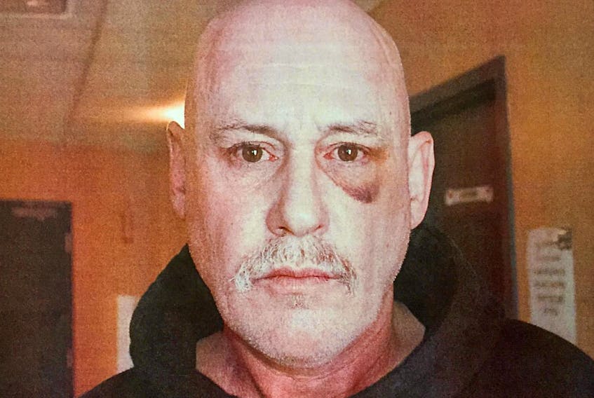 This police photo taken March 5, 2018, shows Patrice Simard’s facial injuries. The Crown alleged Halifax Regional Police Const. Gary Basso struck Simard in the face eight days earlier, breaking his nose.