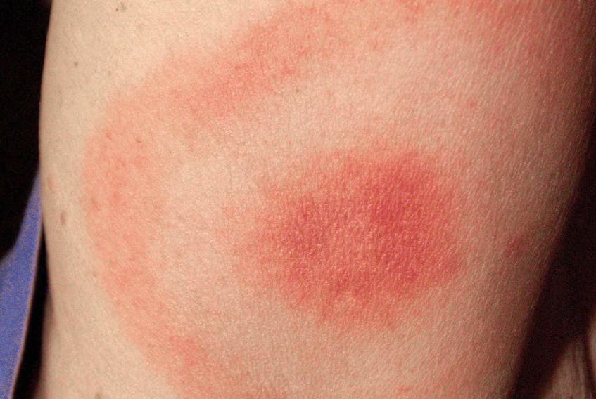
A bullseye rash, the calling card of early stage lyme disease. - James Gathany
