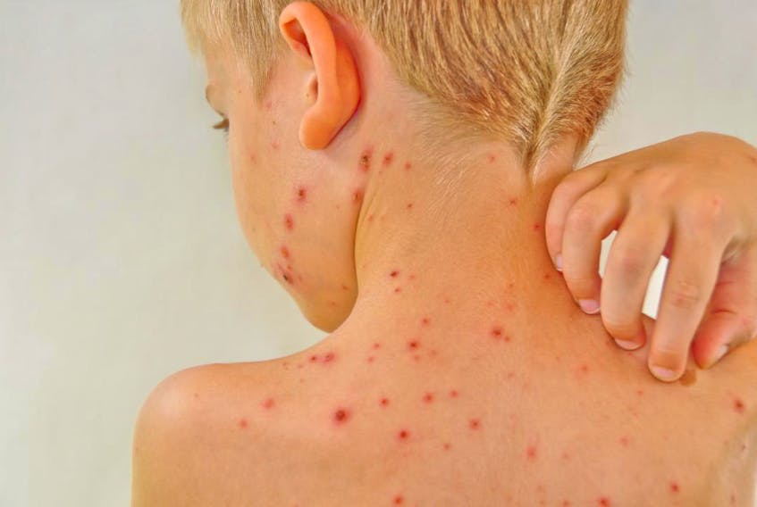 This stock image shows a child suffering from chicken pox.