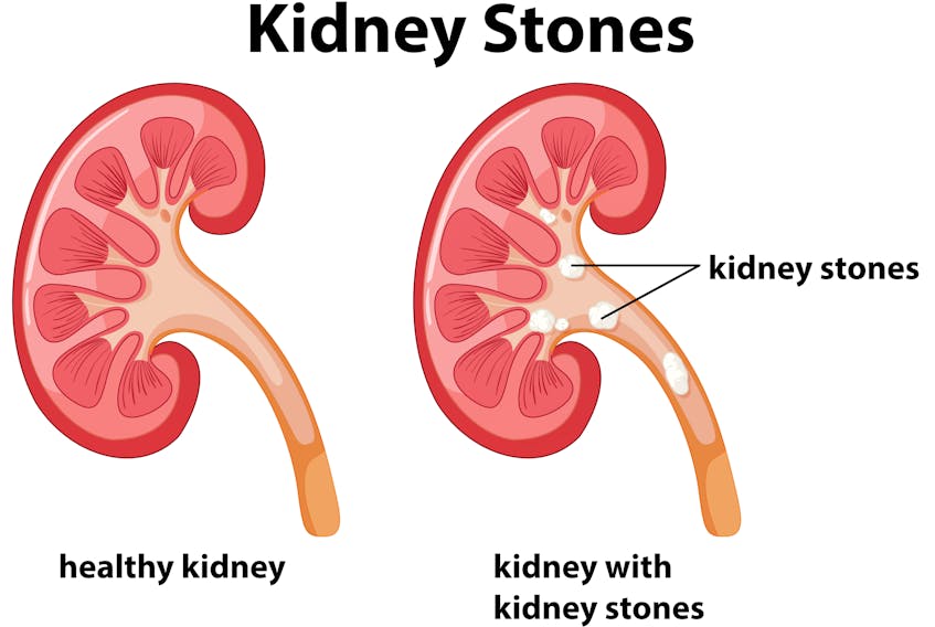 Researchers have studied whether large doses of vitamin C increase the risk of kidney stones.