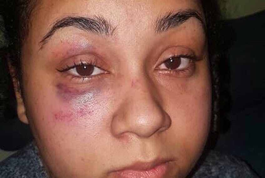 Santina Rao shown with a black eye a day after her arrest at Mumford Road Walmart on Jan 15.  Facebook