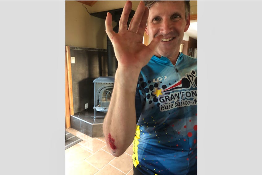 Cyclist Ian White shows his most notable injury – road rash – from his collision with a deer this summer.