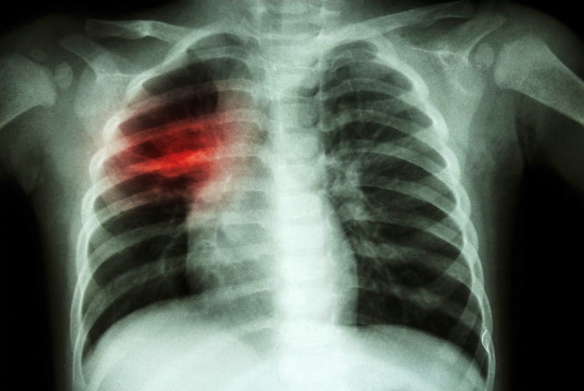 March 24 is World Tuberculosis Day.