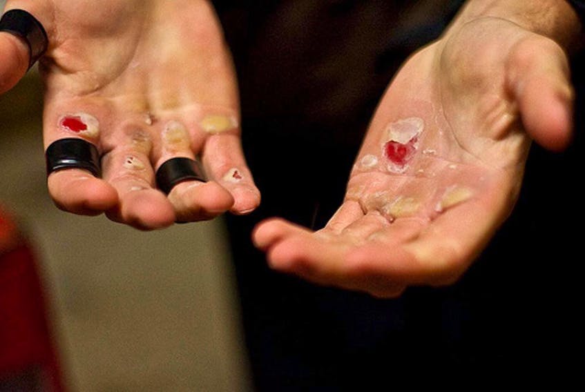 These blistered hands belong to a woman competing in the same Trans-Atlantic rowing race.