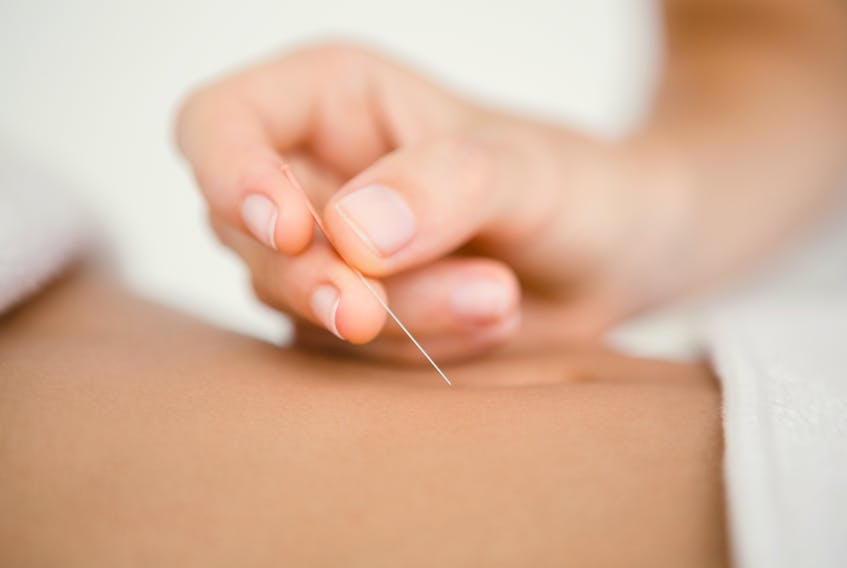 Close up of acupuncture treatment -123RF