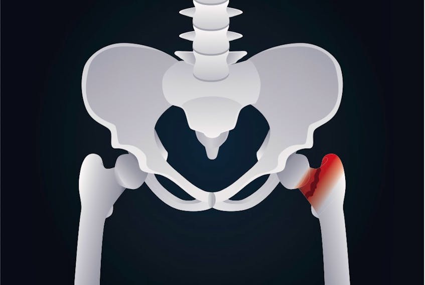 Hip fractures are a common injury sustained in falls in long-term care.