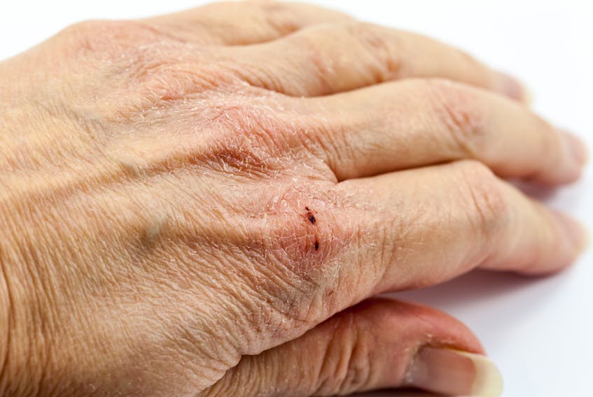 A cracked and chafed hand is seen in this stock image. While frequent washing is one of the best ways to slow the spread of COVID-19, more people have chapped hands — or irritant hand dermatitis — as a result, says a local dermatologist. STOCK IMAGE
