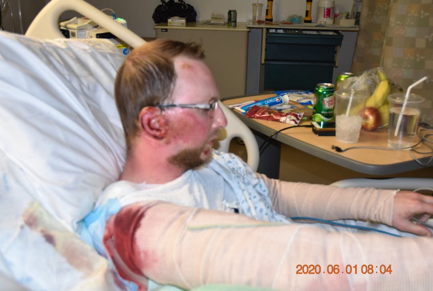 Former Birch Grove resident Jeff MacDonald is continuing his recovery in an Edmonton hospital after a fire destroyed his home on May 30. Friends and family have rallied to help after MacDonald suffered serious burns to his face, hand, arms and feet. CONTRIBUTED