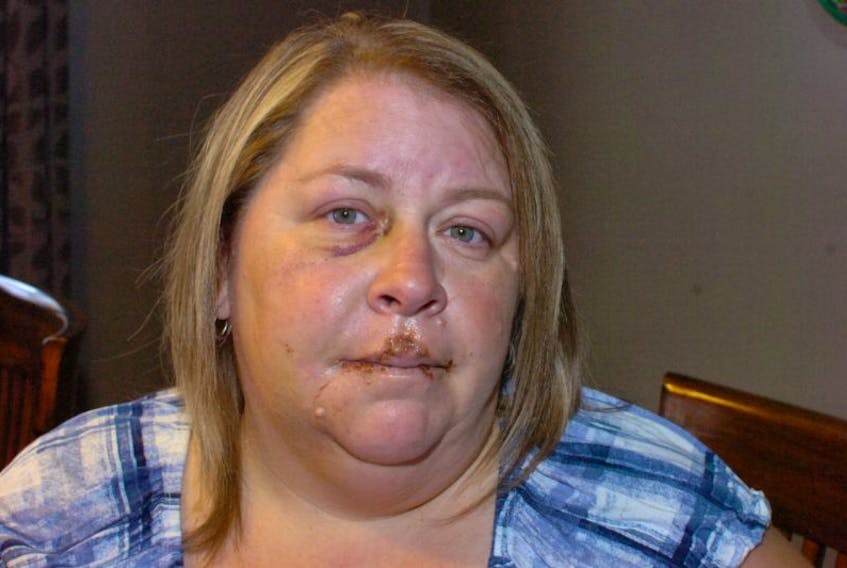 Cheryl Feltham is still feeling the effects of a Dec. 1 incident in which of piece of steel flew off a truck and went through her windshield, striking her in the face.