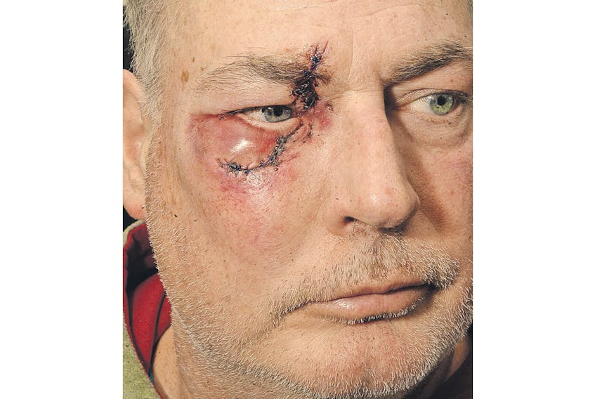 A skate to the face resulted in eight stitches, and waaaay to close to losing an eye.